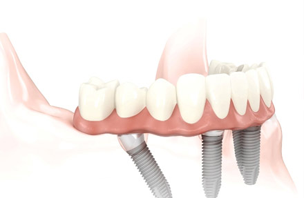 Impianti dentali