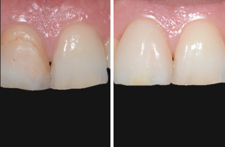 resine estetiche