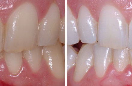 home bleaching