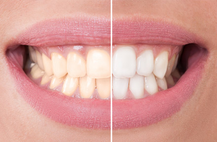 Sbiancamento denti